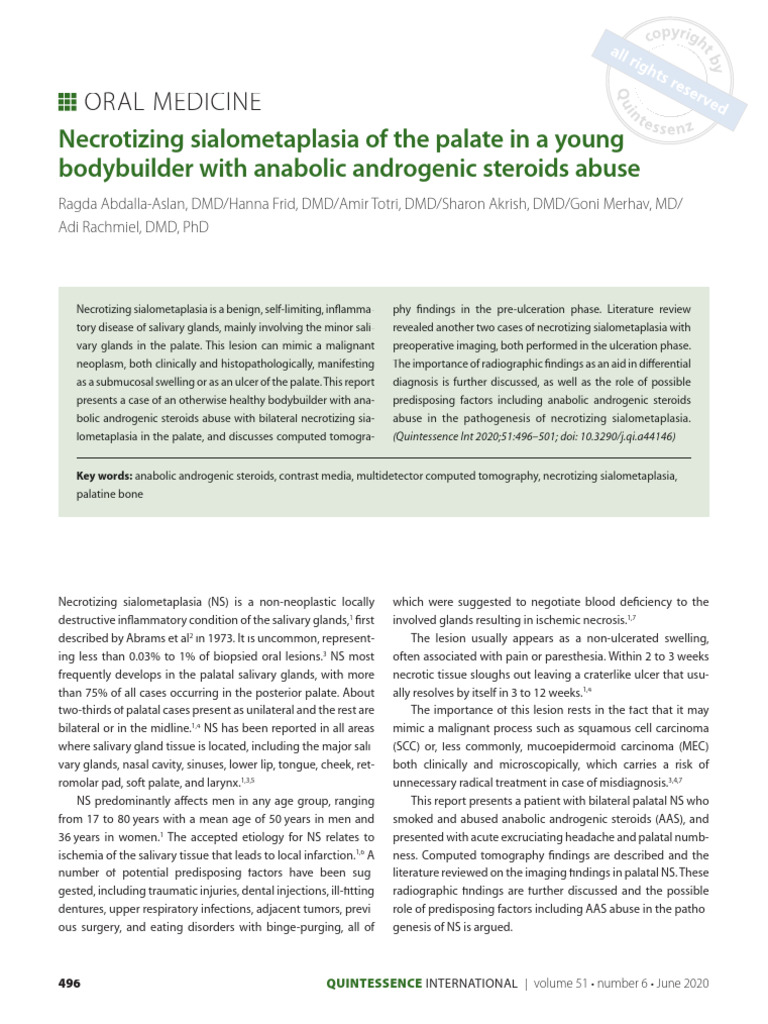 Necrotizing Sialometaplasia of The Palate in A Young Bodybuilder With ...