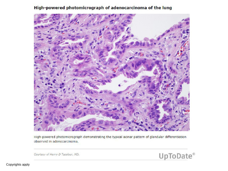 High Powered Photomicrograph of Adenocarcinoma of The Lung | PDF