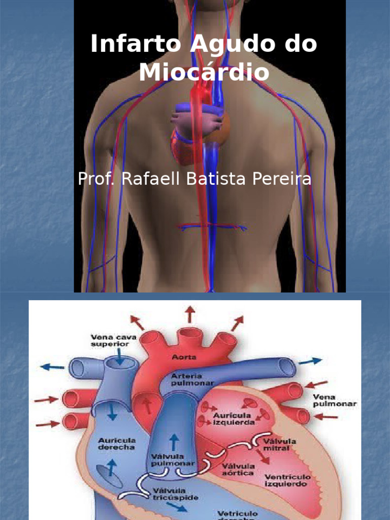 Infarto Agudo do Miocárdio: Causas e Sintomas | PDF | Infarto do ...