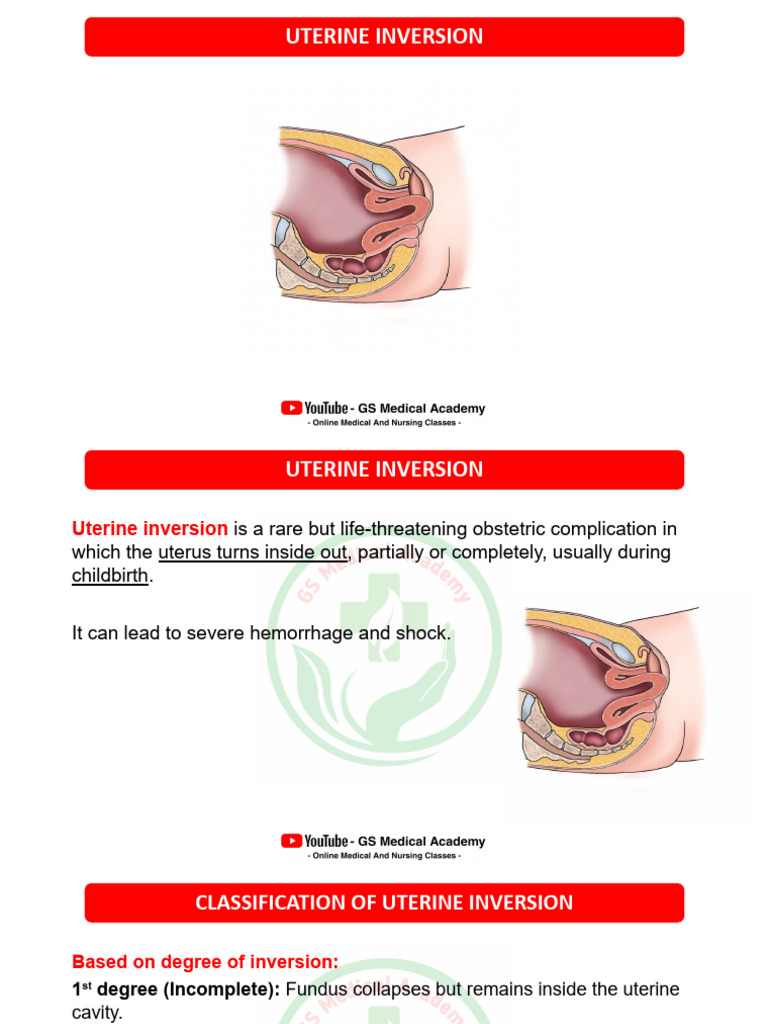 Uterine Inversion: Management & Classification | PDF | Uterus | Childbirth