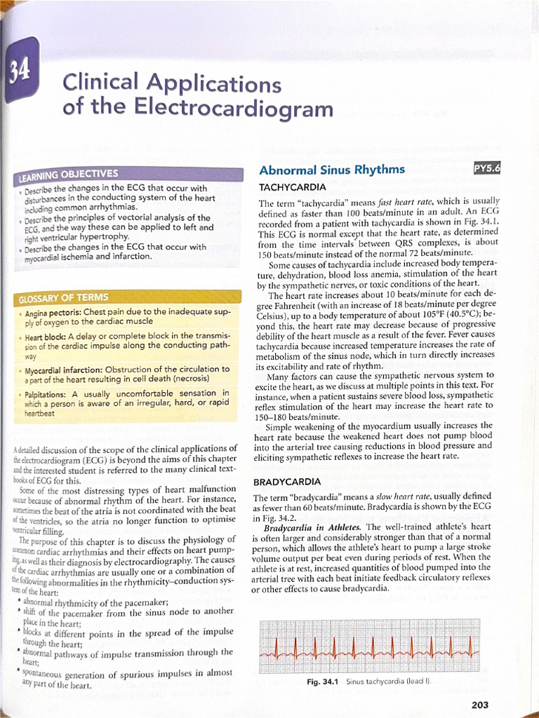 Arrhythmias | PDF
