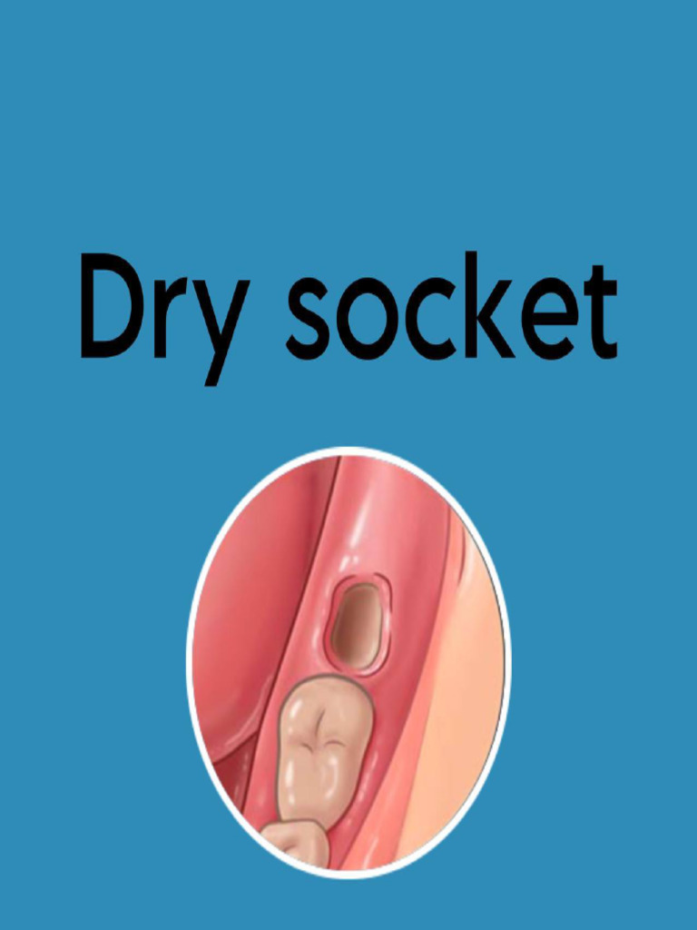 Dry Socket | PDF