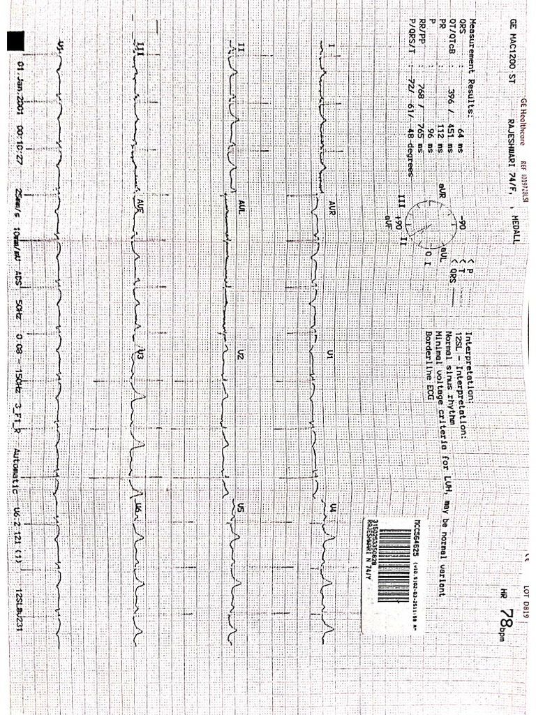 Sample Ecg | PDF