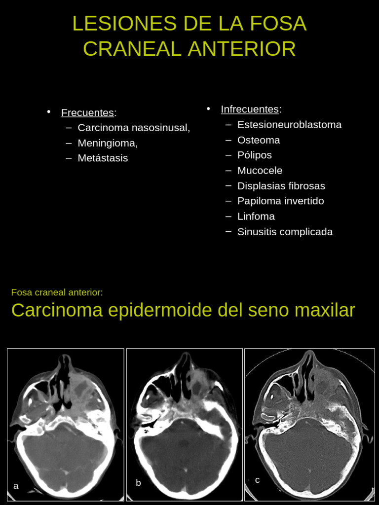 Lesiones de la Fosa Craneal Anterior | PDF | Cráneo | Cabeza y cuello ...