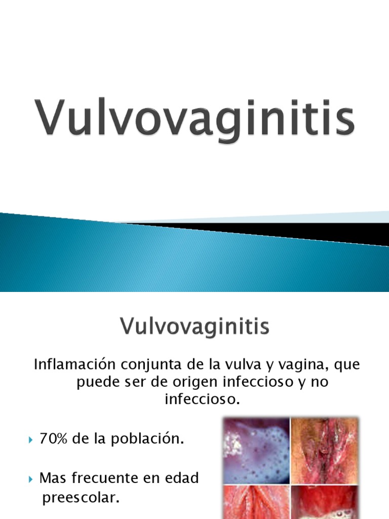 Vulvovaginitis Especialidades Medicas Enfermedades Y Trastornos