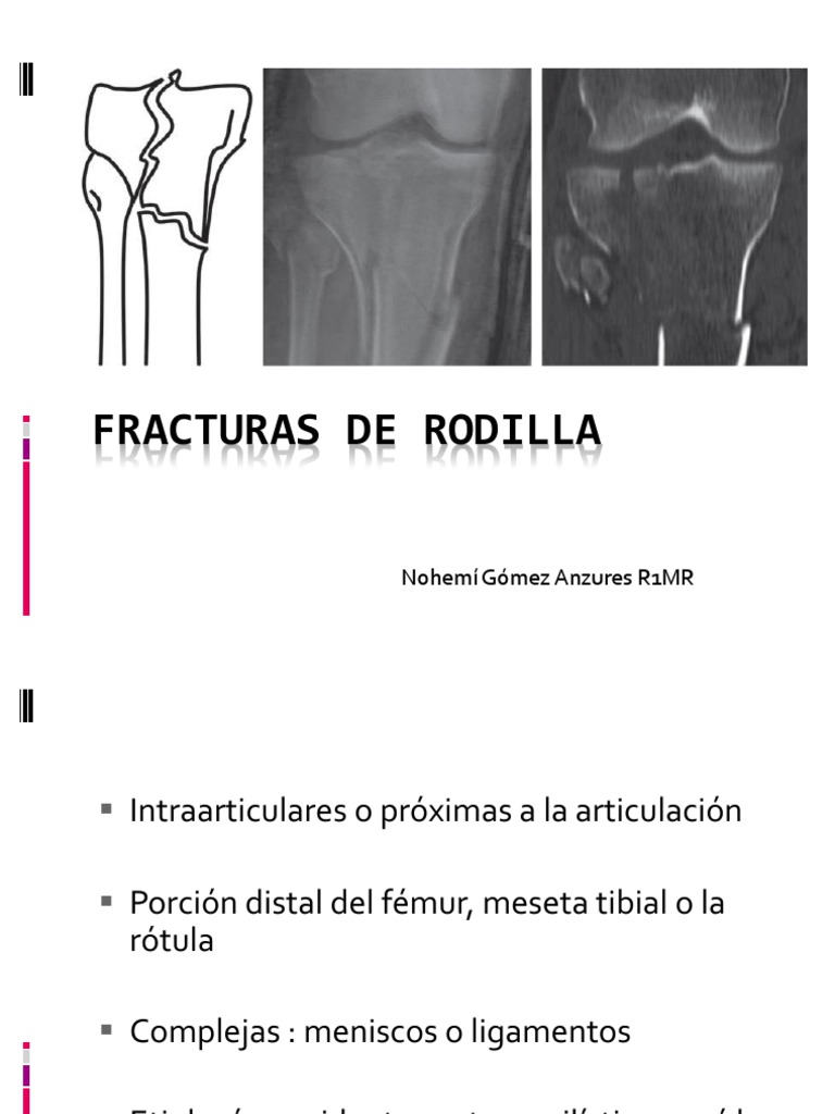 Fracturas de Rodilla | PDF | Rodilla | Articulaciones