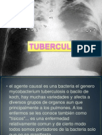 Tuberculosis