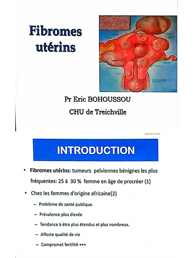 Fibrome Utérins | PDF