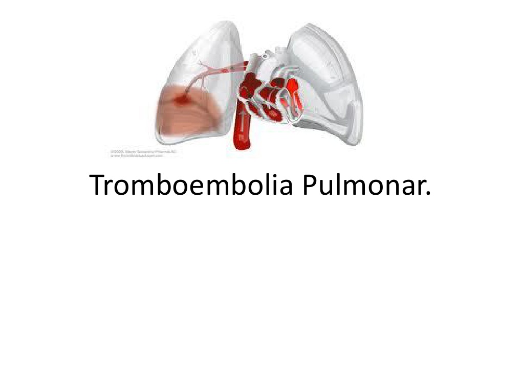 Tromboembolism cu vene varicoase, Tromboembolism cu vene varicoase