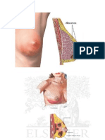 La Mastitis Puerperal Es Una Infección....