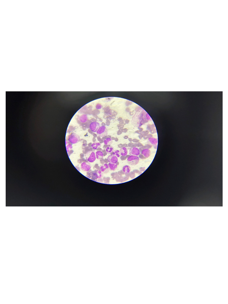 Leukemia Slide 1 | PDF