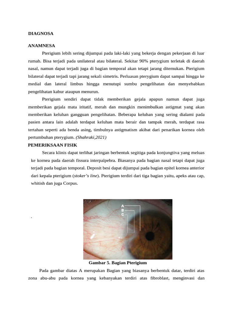 Diagnosa dan Tatalaksana Pterigium | PDF