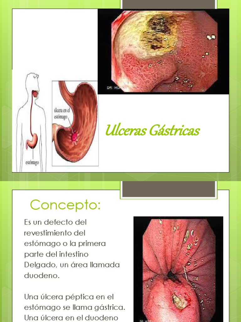 Ulceras gastriicas | Gastroenterología | Medicina CLINICA