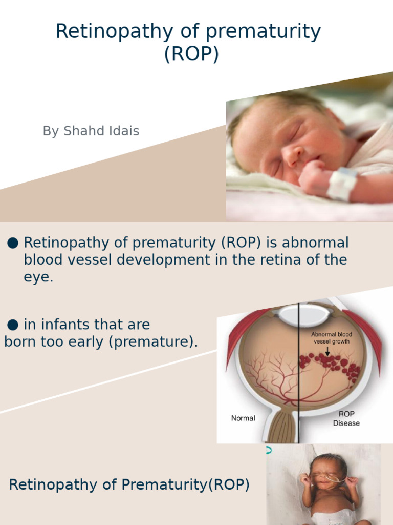 Retinopathy of Prematurity (ROP) : by Shahd Idais | PDF