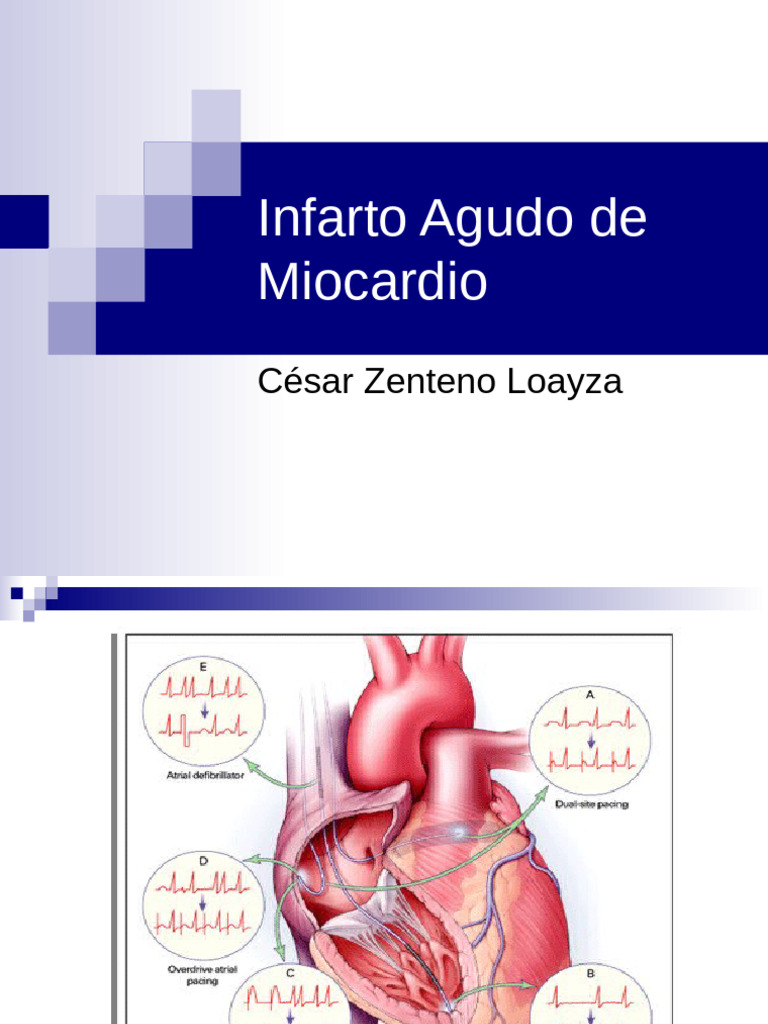 Causas y Tratamiento del Infarto Agudo | PDF | Infarto de miocardio ...