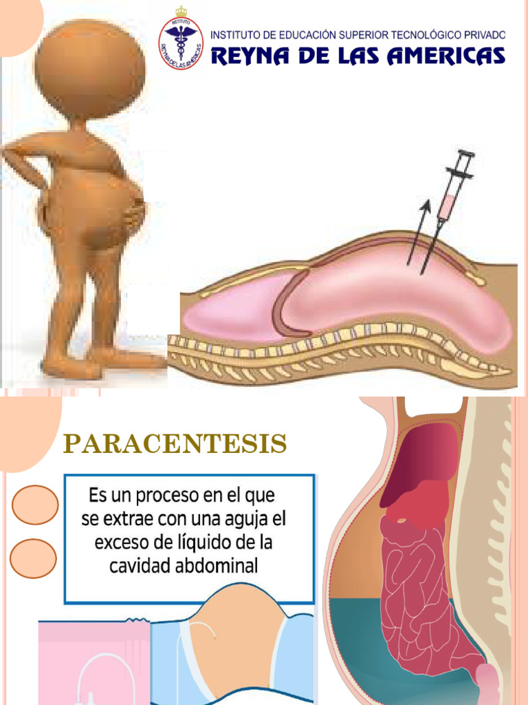 Semana 11.1 Paracentesis | PDF