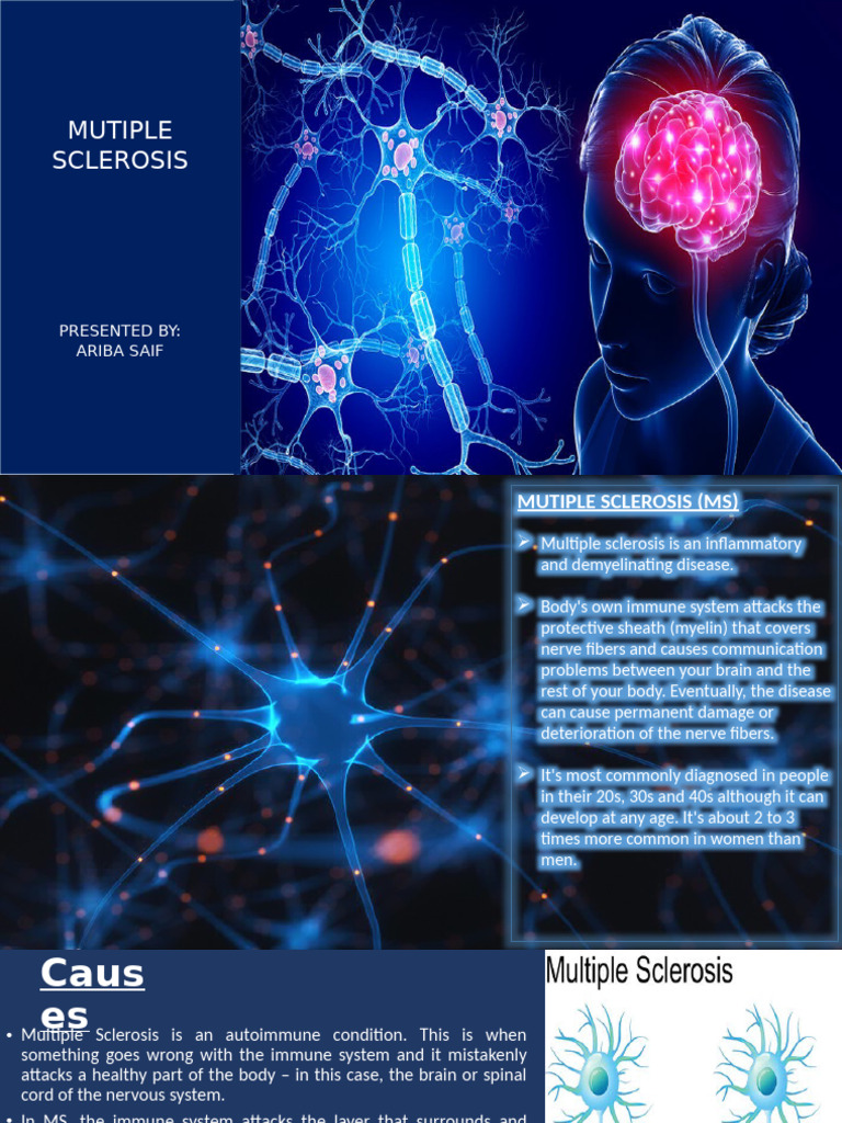 Understanding Multiple Sclerosis (MS) | PDF | Multiple Sclerosis ...