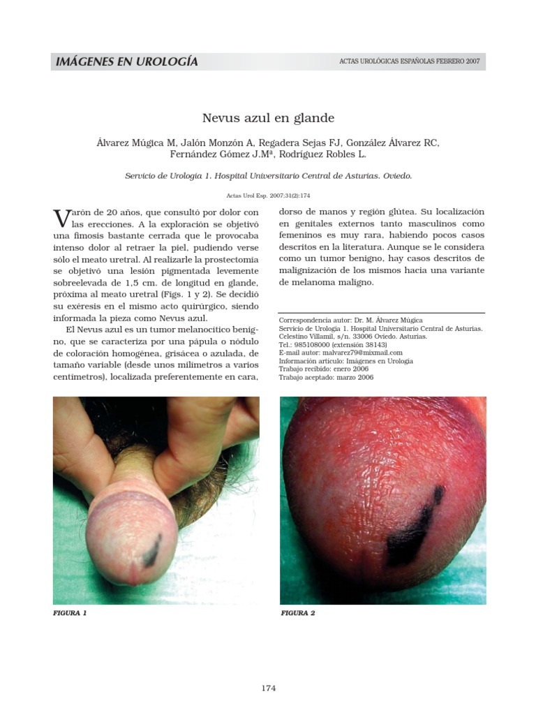 maculas melanoticas glande Nevus azul en el glande masculino | PDF