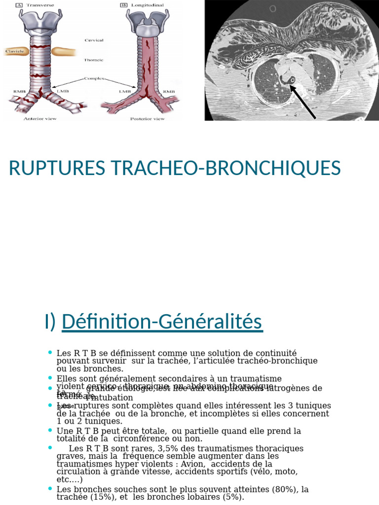 Ruptures trachéo-bronchiques : Analyse clinique | PDF | Poumon ...
