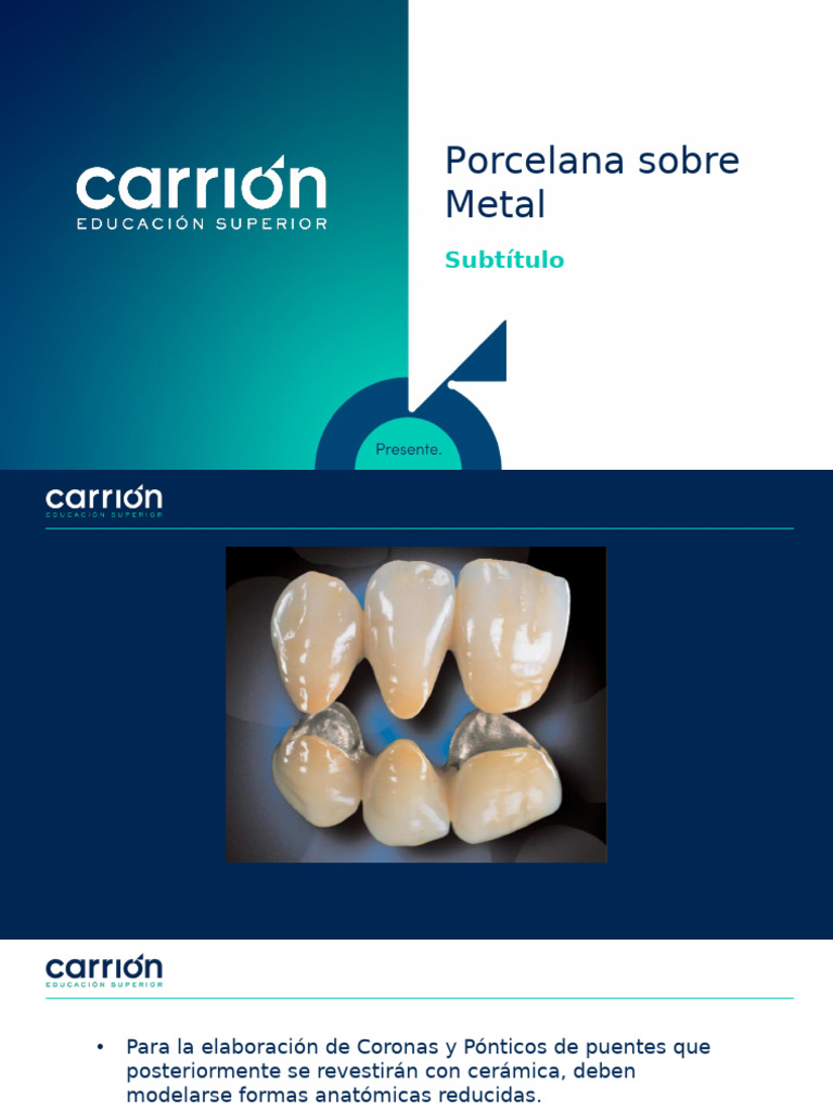 Diseño de Coronas y Pónticos en Metal-Cerámica | PDF
