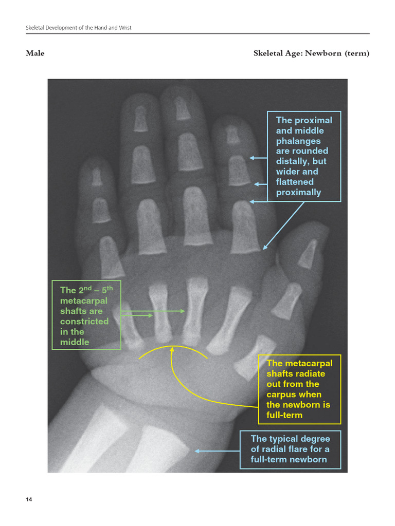 Edad Ósea Oxford | PDF | Hand | Thumb