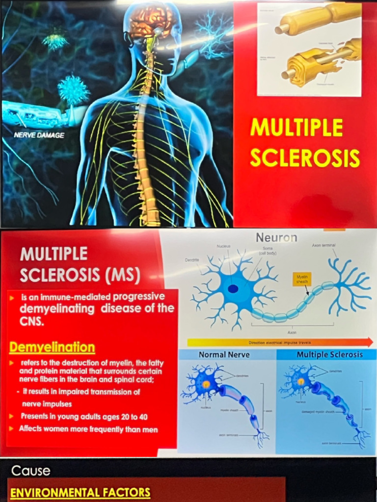 MS (Multiple Sclerosis) Z | PDF