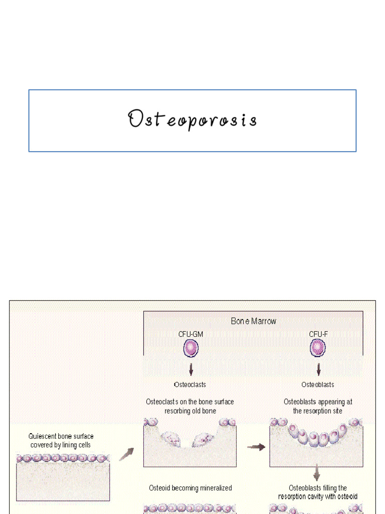 Osteoporosis | PDF | Osteoporosis | Bone