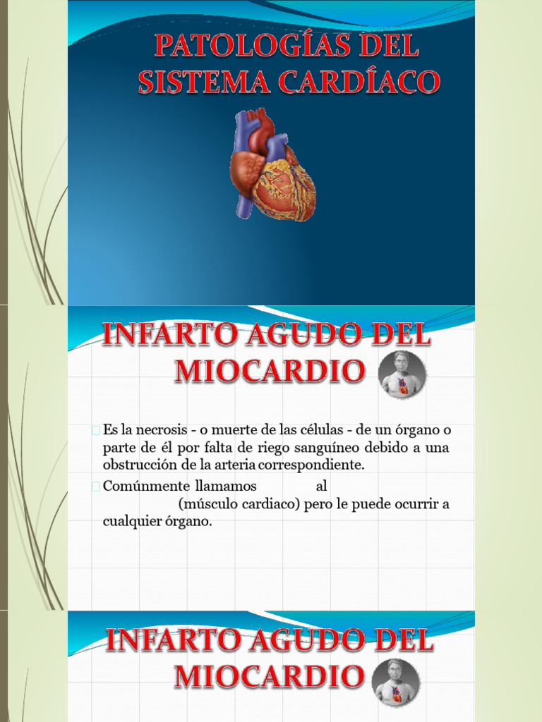 Infarto Agudo de Miocardio: Causas y Síntomas | PDF | Infarto de ...