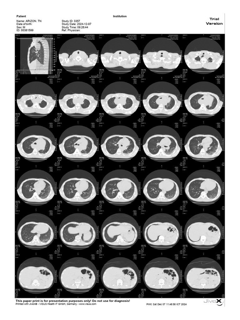Arizon. TN - 00381599 - CT Scan THX NK Lung (Axi) - 07-12-2024 | PDF