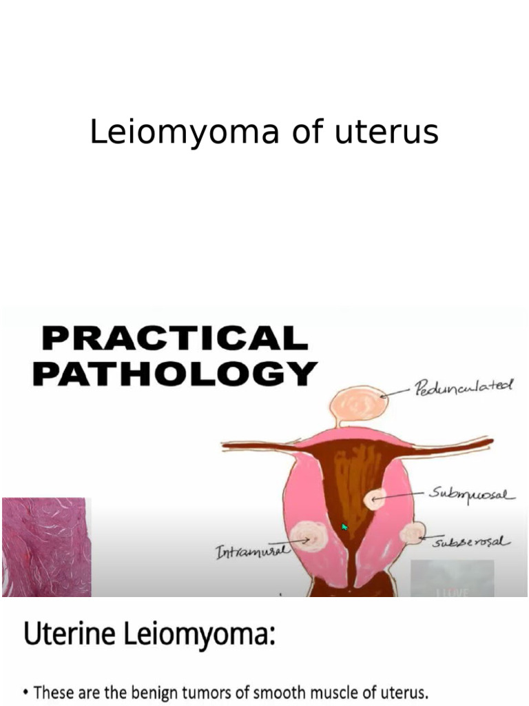 Leiomyoma of Uterus | PDF