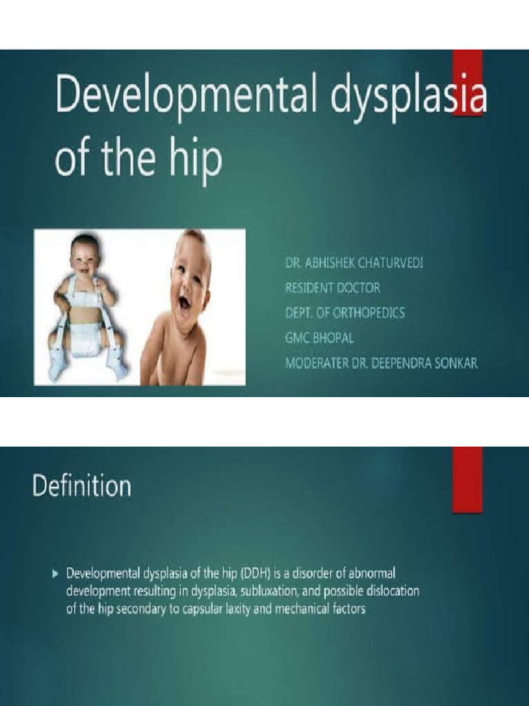 DDH | PDF