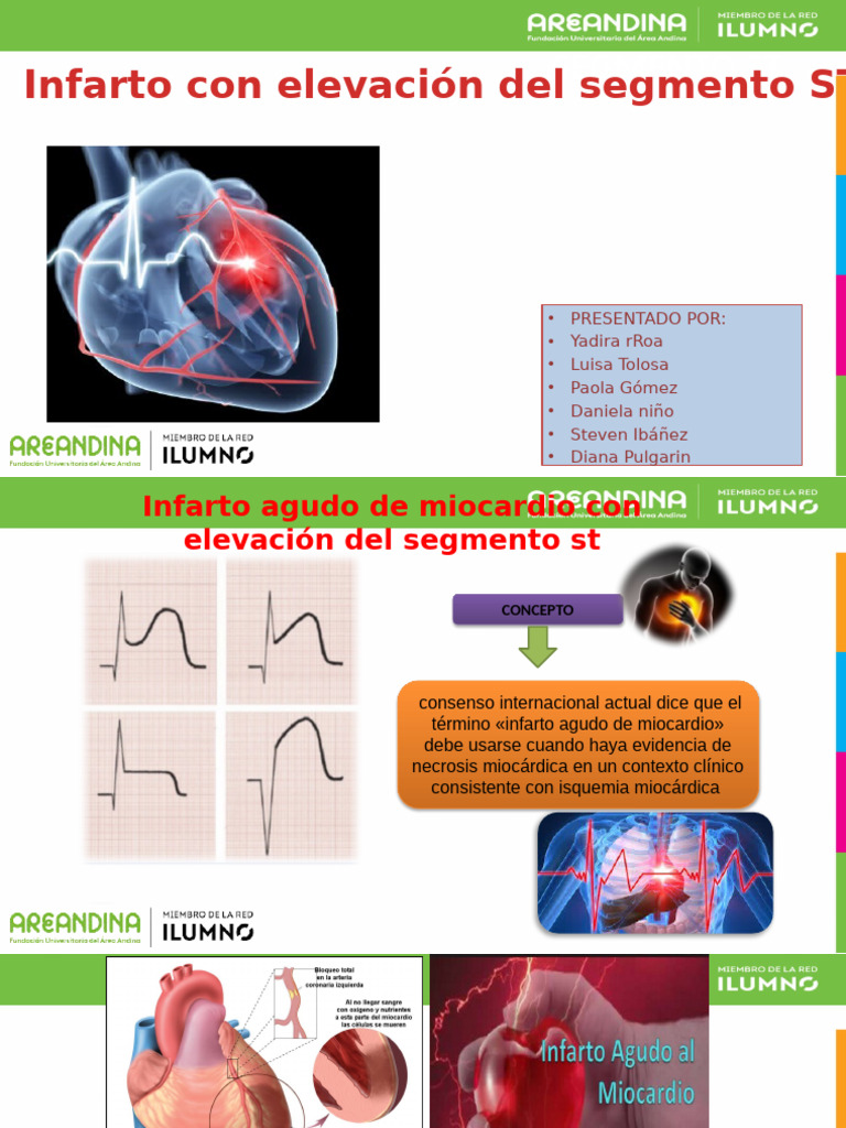 Elevacion Del ST | PDF | Infarto de miocardio | Enfermedades y trastornos