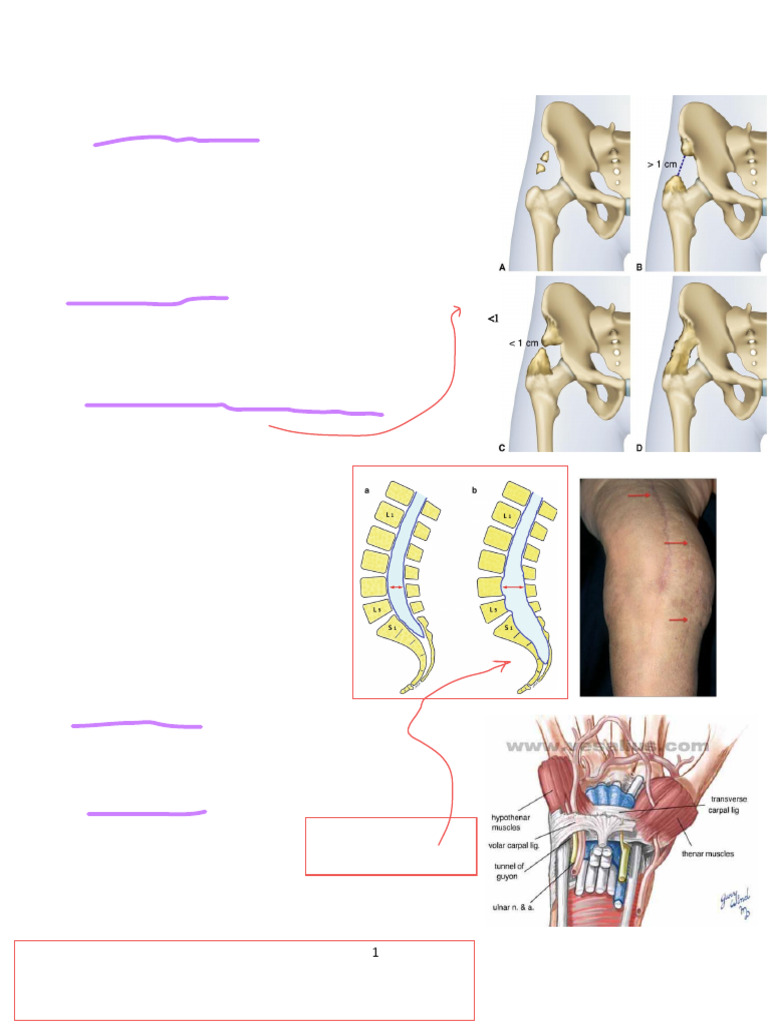Delbet Classification in Femur Fractures | PDF | Knee | Scoliosis