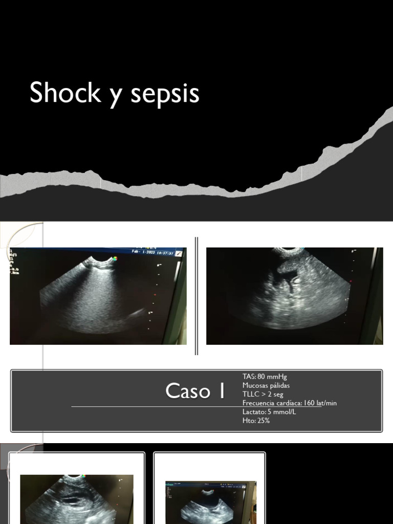 2 Shock y Sepsis | PDF | Vena | Septicemia