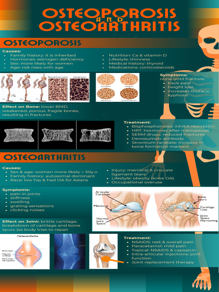 Osteoporosis and Osteoarthritis Overview | PDF | Osteoporosis ...