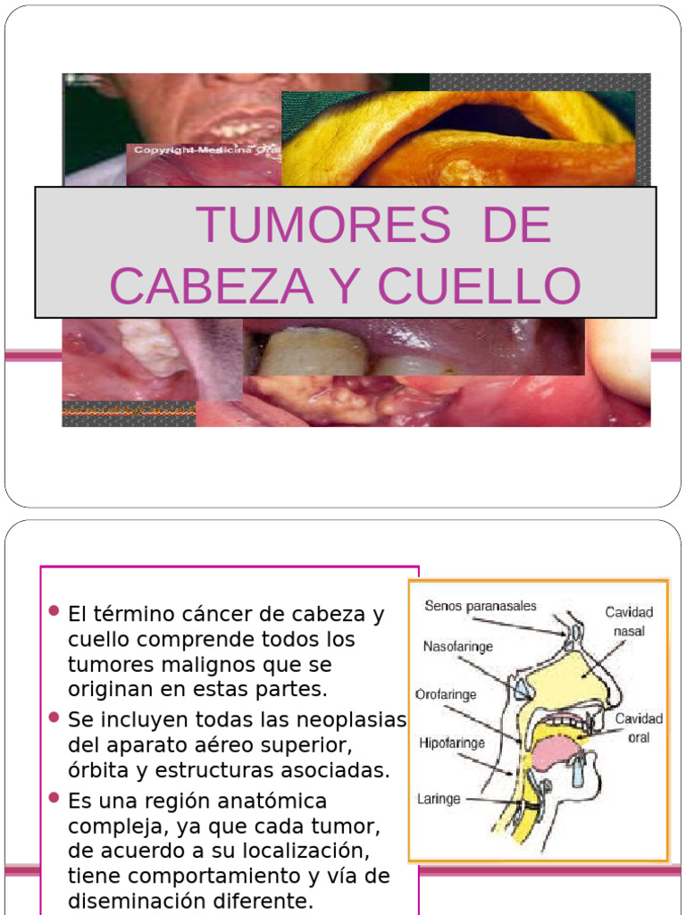 cancer de cabeza y cuello exposicion | PDF | Cáncer | Metástasis