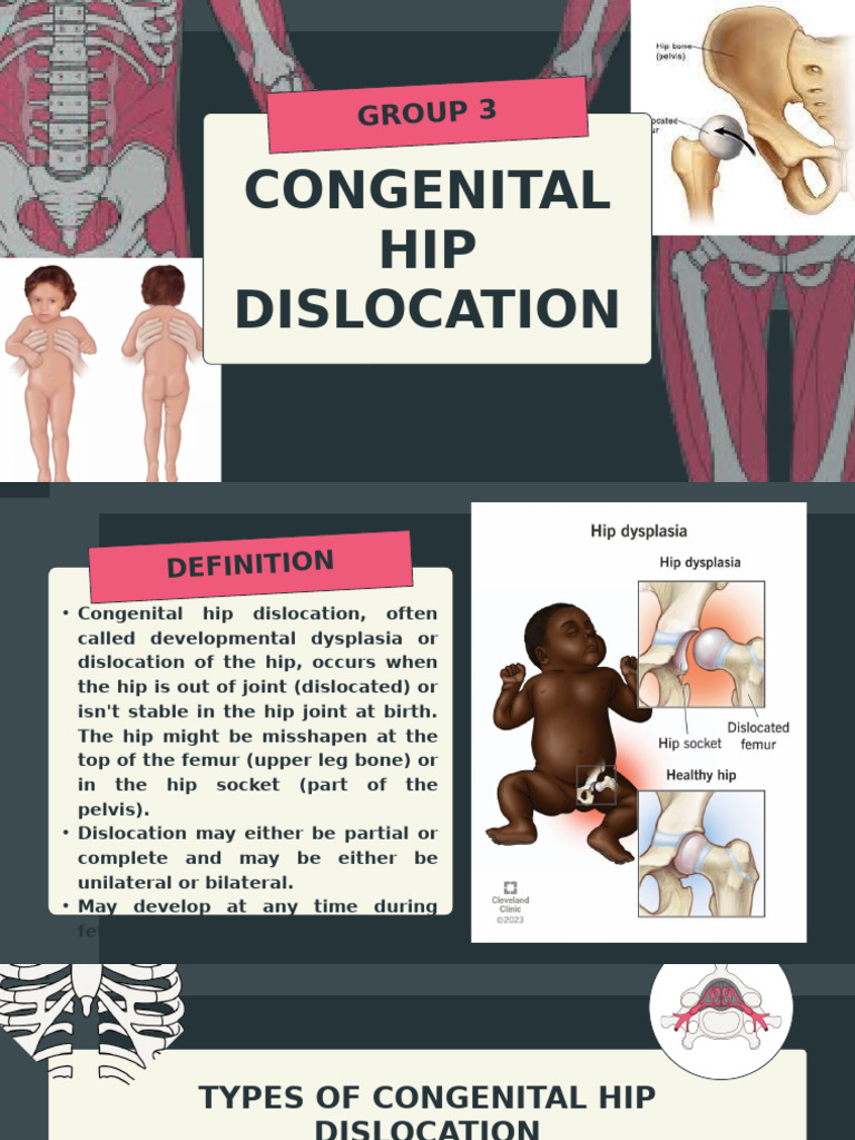 Congenital Hip Dislocation Samuray Emma Rissa 1 | PDF | Hip ...