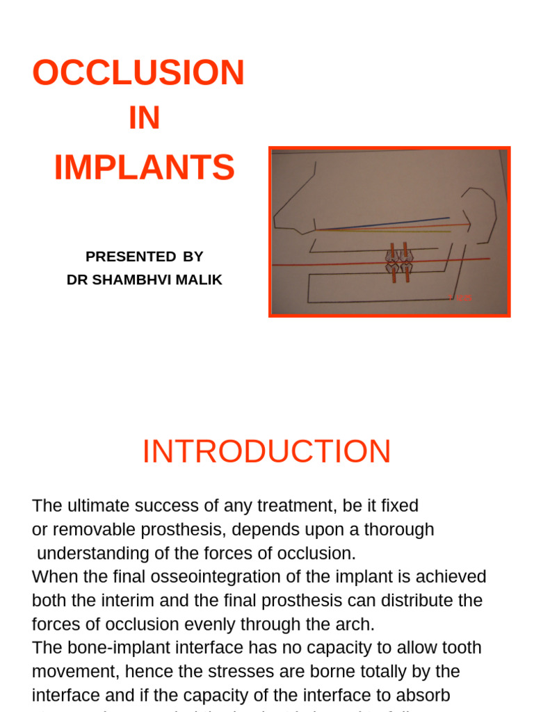Occlusion Principles in Dental Implants | PDF | Dental Implant ...
