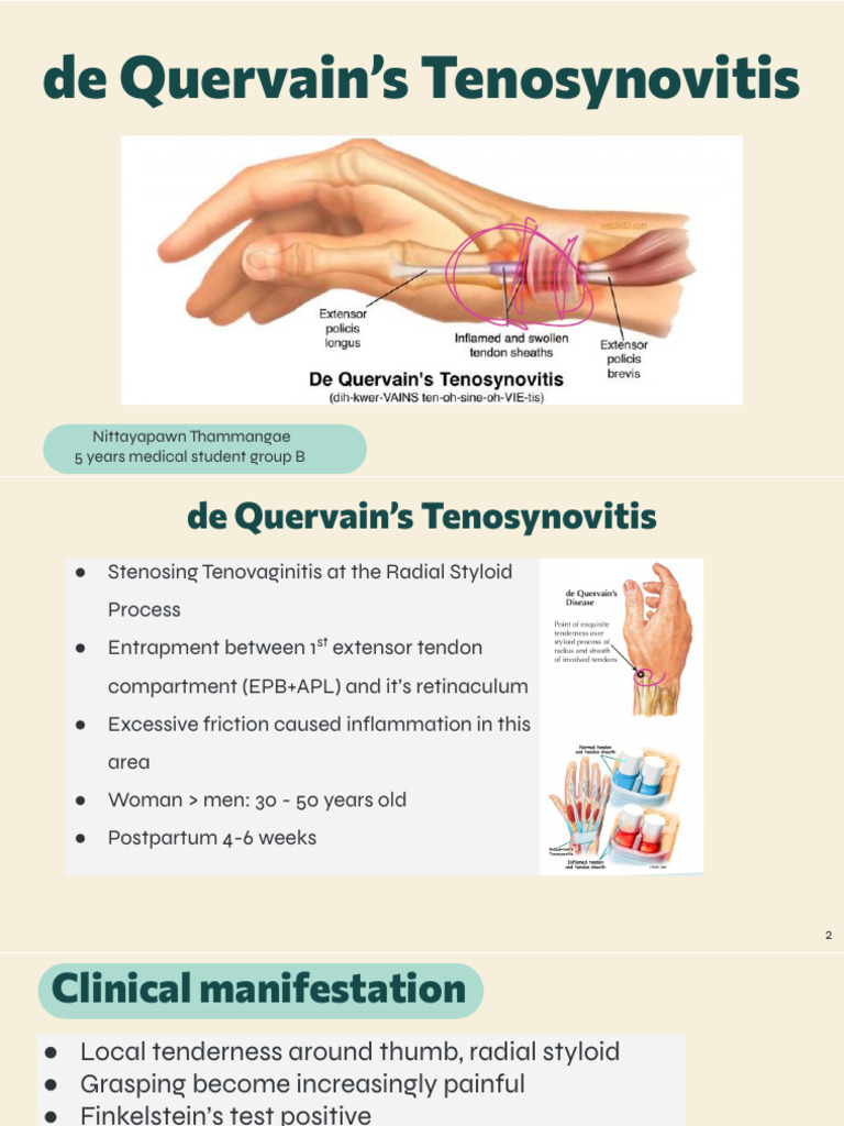 De Quervain's Tenosynovitis | PDF