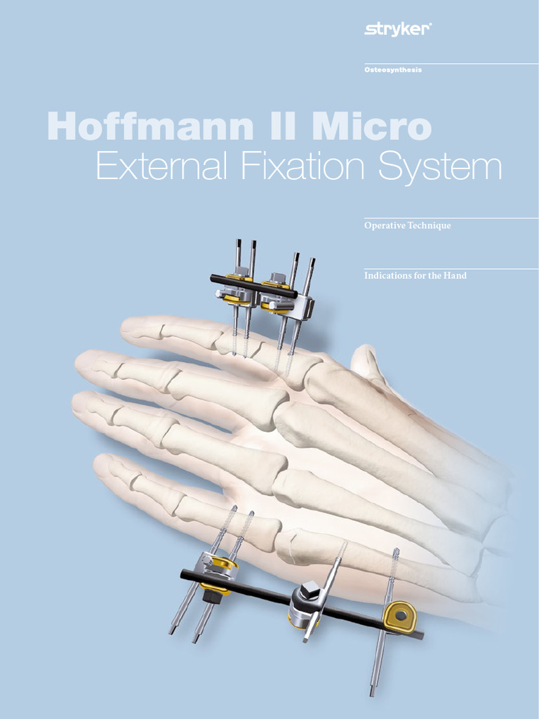 Hoffmann II Micro Fixation Guide | PDF | Screw