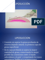 LIPOSUCCION