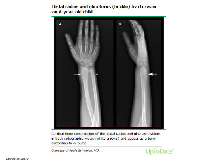 Buckle_fracture_radius_ulna | PDF