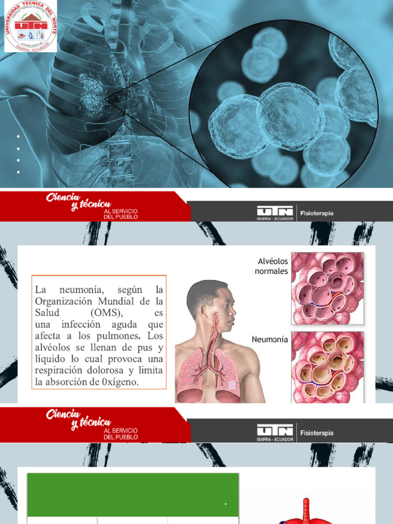 Tipos y Diagnóstico de Neumonía | PDF | Neumonía | Tos
