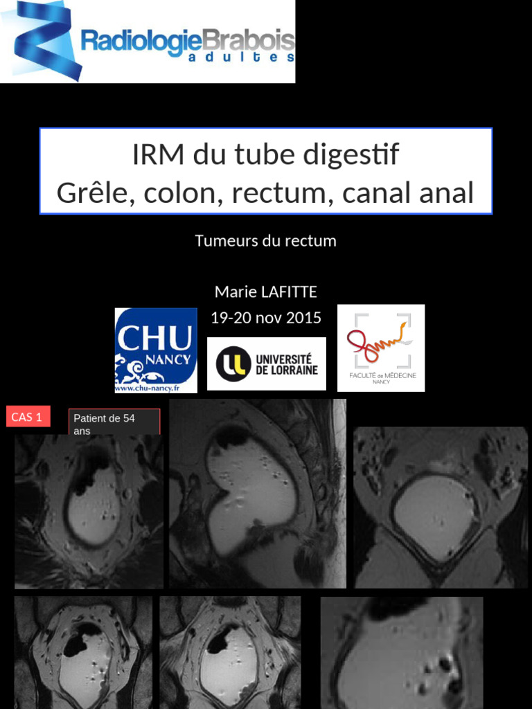 Tumeurs rectales : classification et évaluation | PDF | Rectum ...