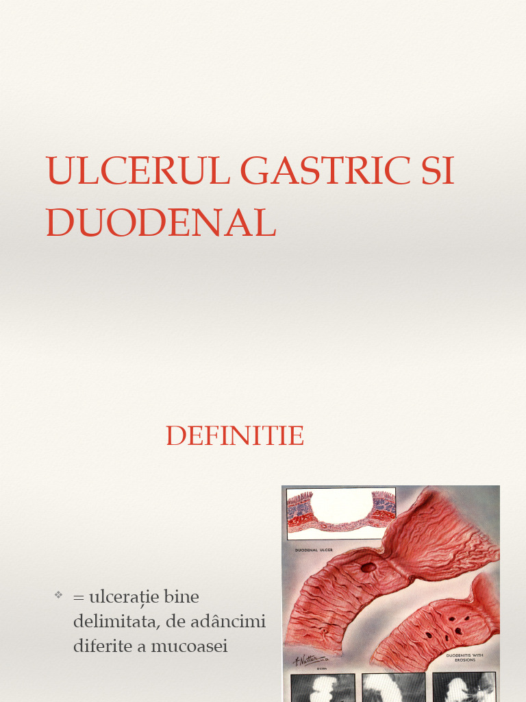Curs V Ulcerul Gastric Si Duodenal | PDF
