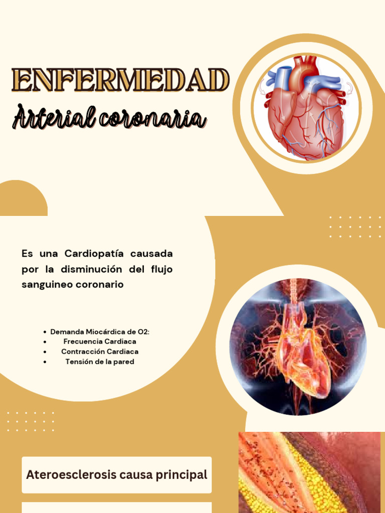 Enfermedad Arterial Coronaria | PDF | Infarto de miocardio | Aterosclerosis