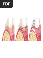Miller Classification of Marginal Tissue | PDF | Periodontology ...