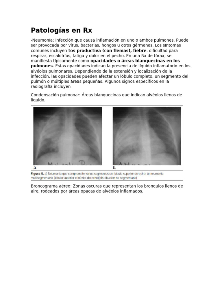 Cefalización en Radiografías Pulmonares | PDF | Pulmón | Tórax