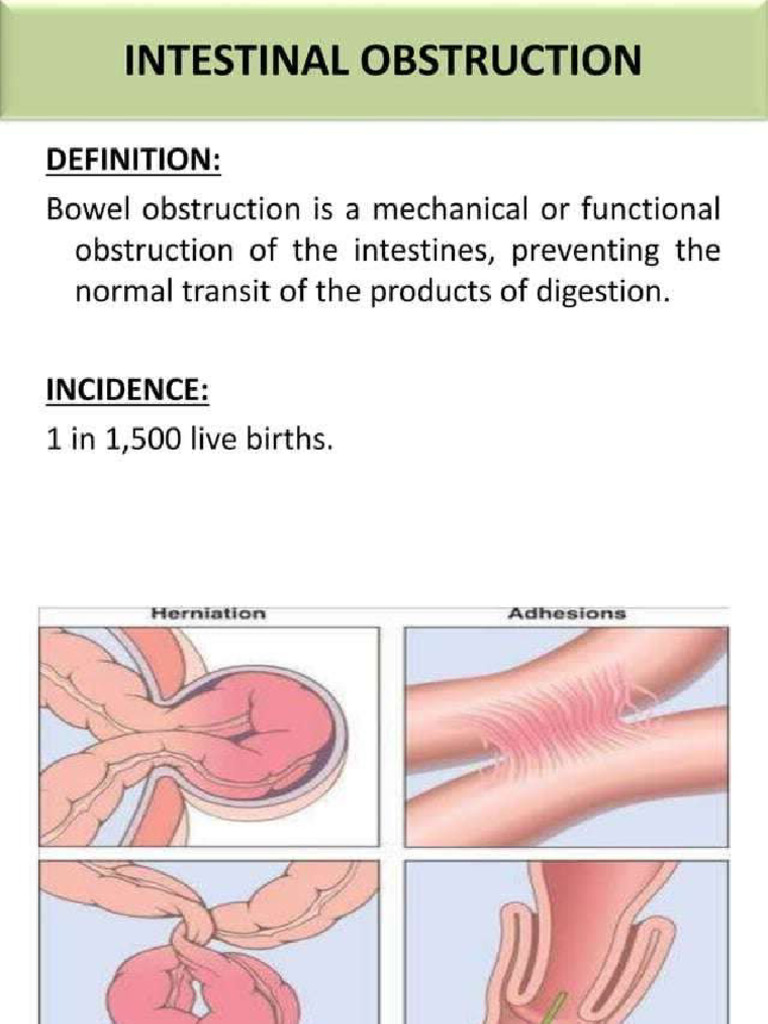 Intestinal Obstruction: Causes & Management | PDF
