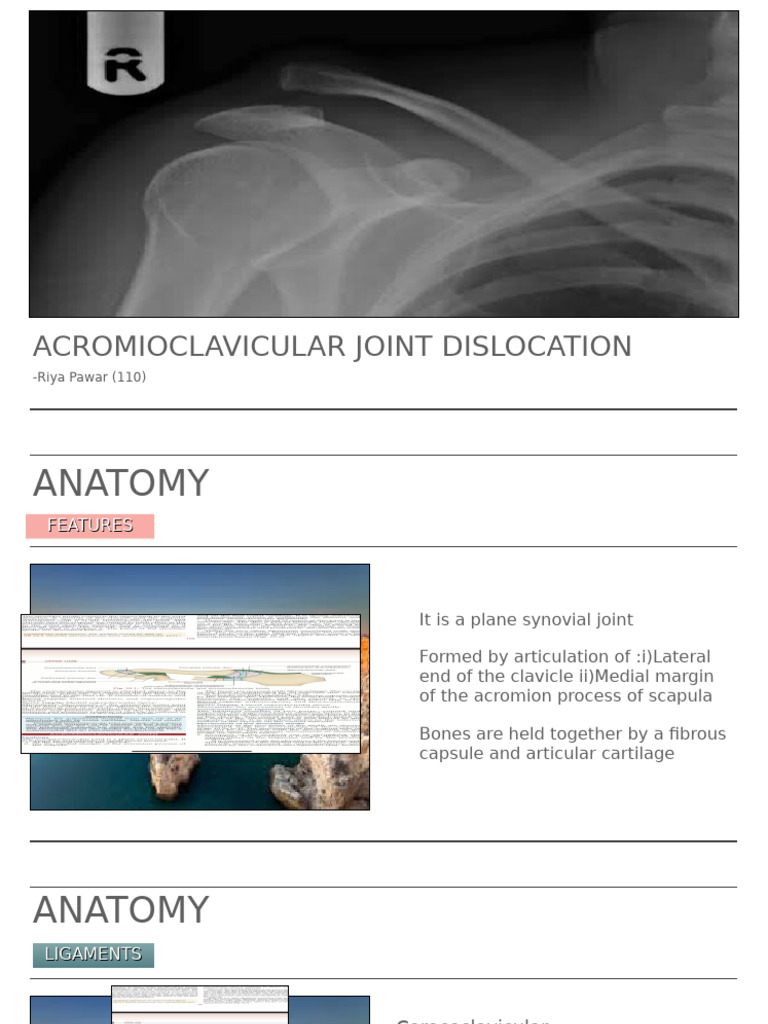 AC Joint Dislocation Overview | PDF | Shoulder | Skeletal System